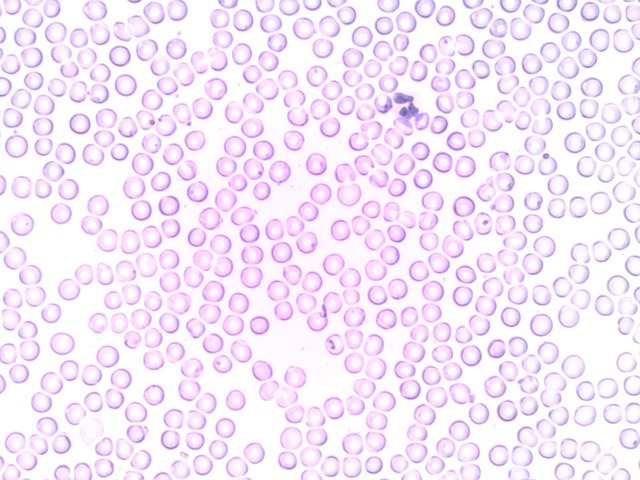 hematologista